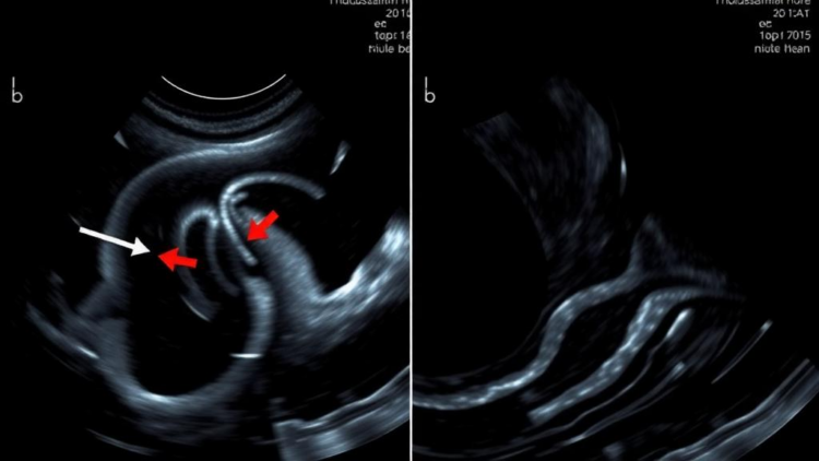 Ultrasound Strain Imaging Spots Hidden Heart Iron in Thalassemia Children Before MRI Can