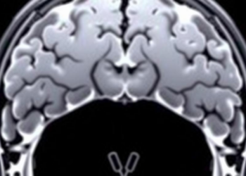 Sudden Stress Surges, Not Chronic Load, Push Cancer Cells Toward Invasive Growth, MRI-Tracking Sensors Reveal