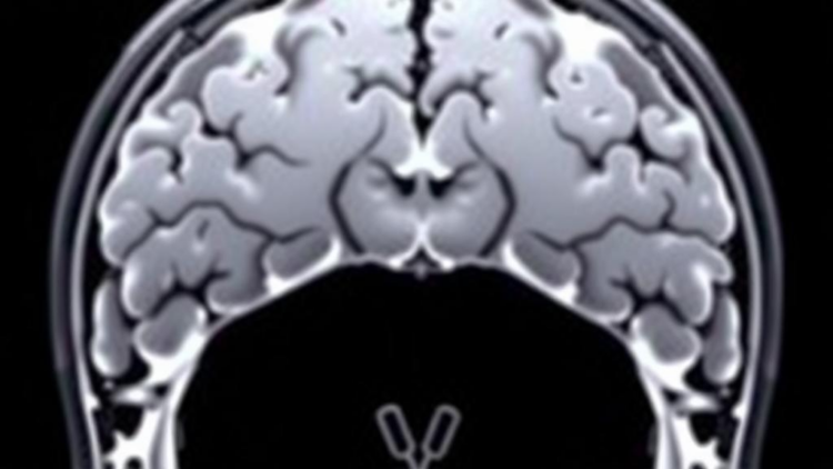 Sudden Stress Surges, Not Chronic Load, Push Cancer Cells Toward Invasive Growth, MRI-Tracking Sensors Reveal