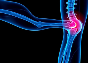Radiofrequency Ablation Shows Promise for Stubborn Thigh Nerve Pain