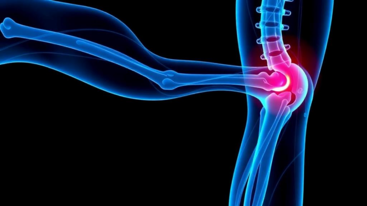 Radiofrequency Ablation Shows Promise for Stubborn Thigh Nerve Pain