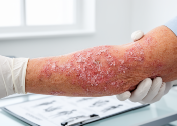 Rare Skin Disease Pityriasis Rubra Pilaris Linked to Higher Odds of Leukemia and Lymphoma