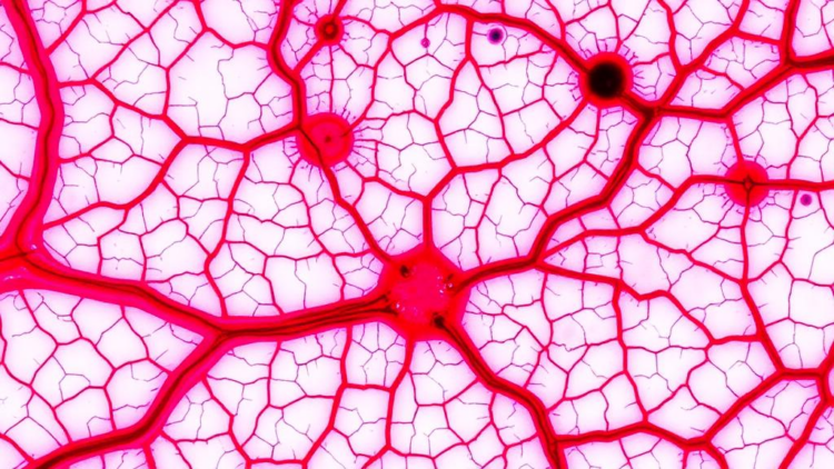 Blood Vessel Patterns Under the Microscope Reveal Which Sebaceous Skin Tumors Turn Deadly