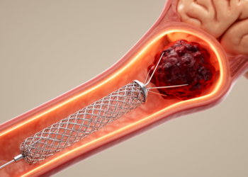 Rescue Stents May Turn Failed Stroke Procedures Into Better Outcomes, German Registry Suggests