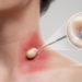 Modified Acupuncture Needle Offers Minimally Invasive Route to Lymph Node Molecular Profiling