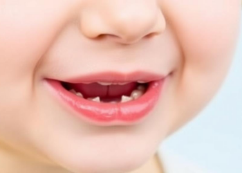 Cleft palate genetics study finds no common variant link to neurodevelopmental risk