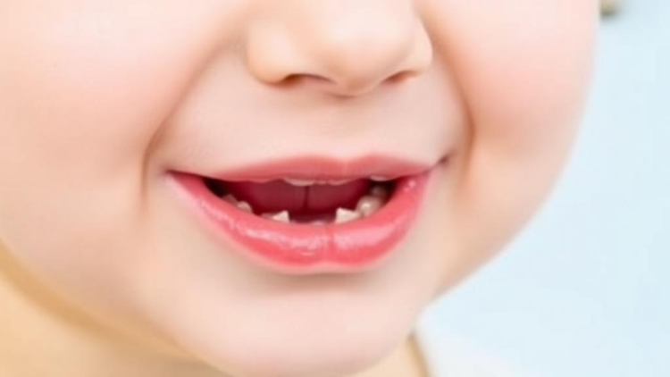 Cleft palate genetics study finds no common variant link to neurodevelopmental risk