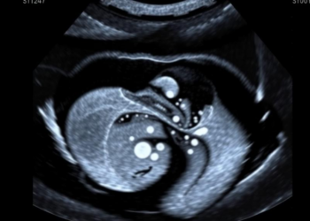 Deep Learning Model Matches Experts at Measuring Fetal Brain Fluid in Ultrasound