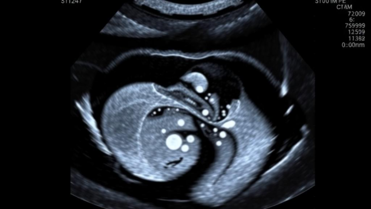Deep Learning Model Matches Experts at Measuring Fetal Brain Fluid in Ultrasound