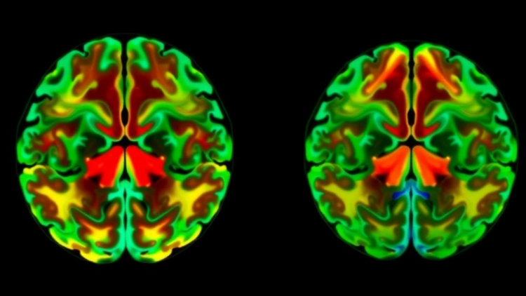 Thalamus Brain Maps Reveal Two Distinct Schizophrenia Biotypes