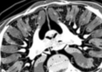 AI Finds Hidden Osteoporosis in Everyday CT Scans, Study Shows