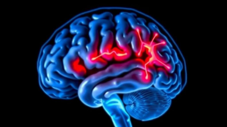 Brain Scan Fingerprints of Parkinson’s Emerge Years Before Symptoms Appear