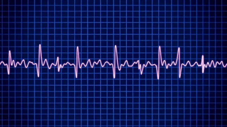 AI Turns a Routine ECG Into a Powerful Predictor of Hidden Heart Artery Disease