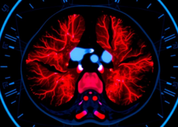 Spectral CT Scan Before Treatment May Predict How Lymphoma Patients Respond