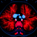 Spectral CT Scan Before Treatment May Predict How Lymphoma Patients Respond