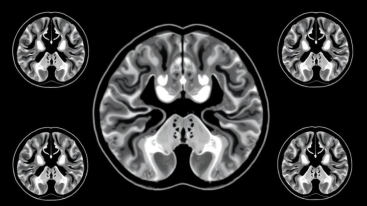 MRI Radiomics Model Predicts Survival in Colorectal Cancer With Liver Metastases