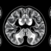 MRI Radiomics Model Predicts Survival in Colorectal Cancer With Liver Metastases