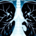 CT Scans Teach Chest X-ray AI to Spot Lung Disease With Far Less Data