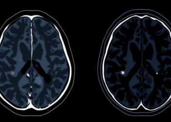 AI Fuses PET and MRI Scans to Predict Prostate Cancer Aggressiveness Before Surgery