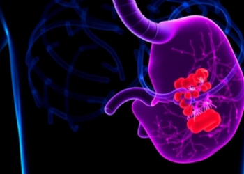 Residual Tumor Burden After Immunotherapy Predicts Survival in Esophageal Cancer
