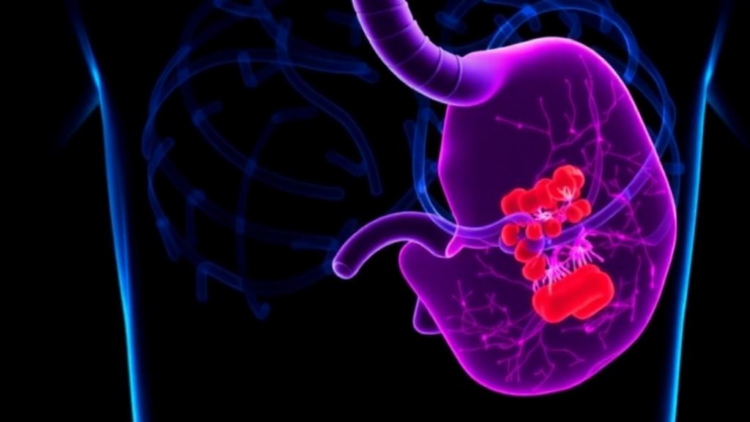Residual Tumor Burden After Immunotherapy Predicts Survival in Esophageal Cancer